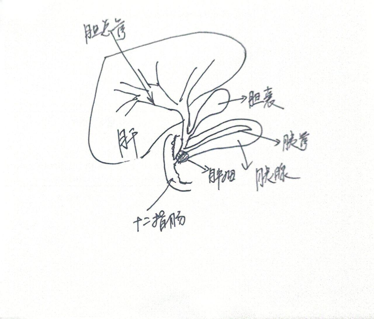 这是我们一个月前治疗的一名胰腺癌患者，病人来自山西，女性，71岁，因黄疸在当地医