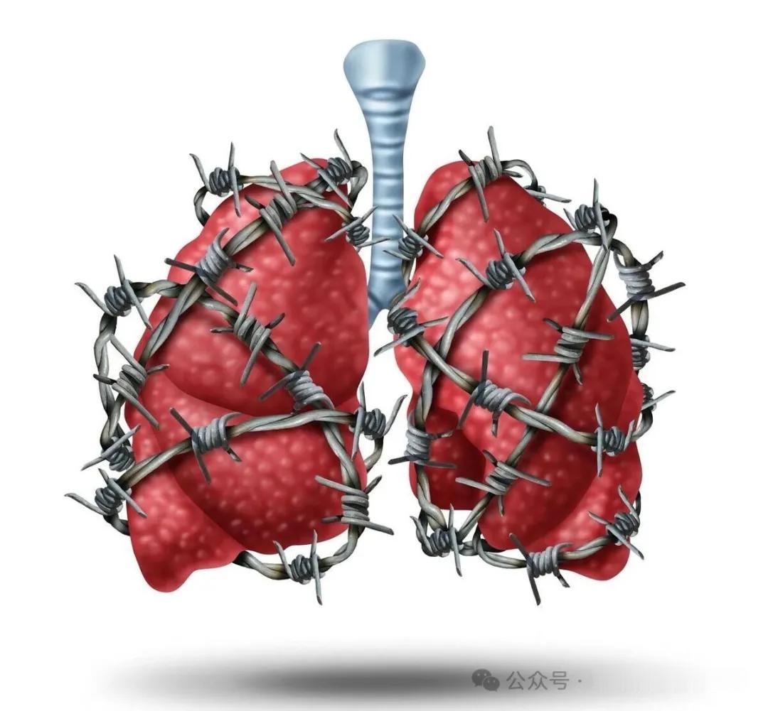 肺病当中的破坏之王，终末期比肺癌还痛苦。但99%的人不知道这个疾病的名字，破坏得