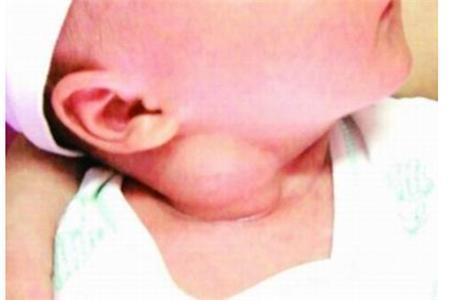 3月宝宝一觉醒来脖子变僵硬, 若出现这症状家长要警惕!