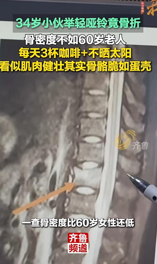 近日，浙江一位34岁的李先生，在健身房一次再普通不过的加重训练中，竟然生生把自己