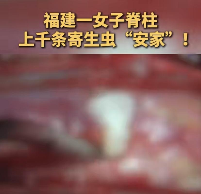 福建一位57岁的李阿姨，近两年一直被腰痛腿痛折磨，严重到几乎瘫痪、没法正常走路，
