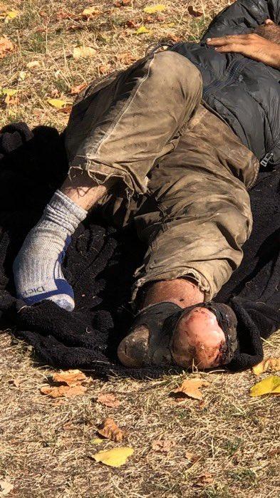 西雅图流浪汉实拍：一只脚已经开始发肿溃烂！此照片拍摄于2023年，是所谓的西雅图