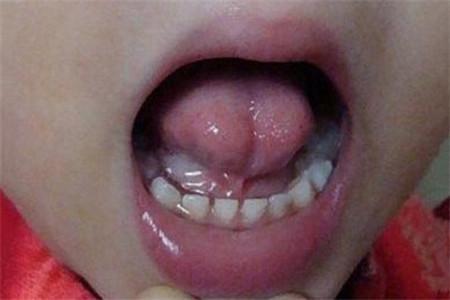 快看看你家宝宝是这种舌头吗? 多数家长仍不知真相