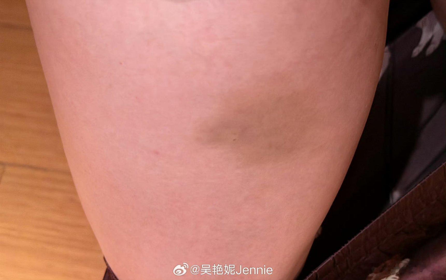 吴艳妮腿上好多淤青吴艳妮运动员光鲜亮丽的外表下，是无数的伤病。2026全国田径冠