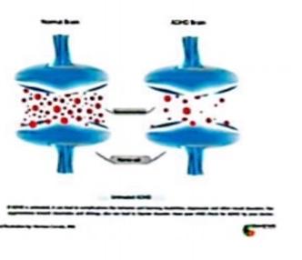 ADHD是一个大脑的疾病大脑结构异常  ·全脑灰质/白质/皮层下结构体积减少
