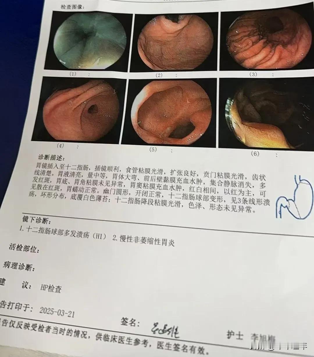 逆转萎缩性胃炎需做好的四件事1.优先根除幽门螺杆菌（Hp）约70%的萎