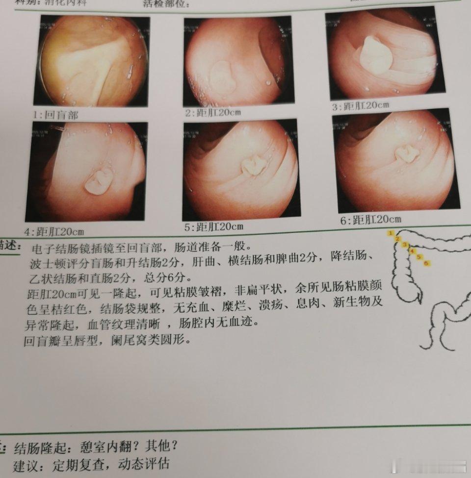 结肠憩室内翻是指结肠壁上的憩室（向外突出的囊状结构）因肠道压力变化、炎症等因素，