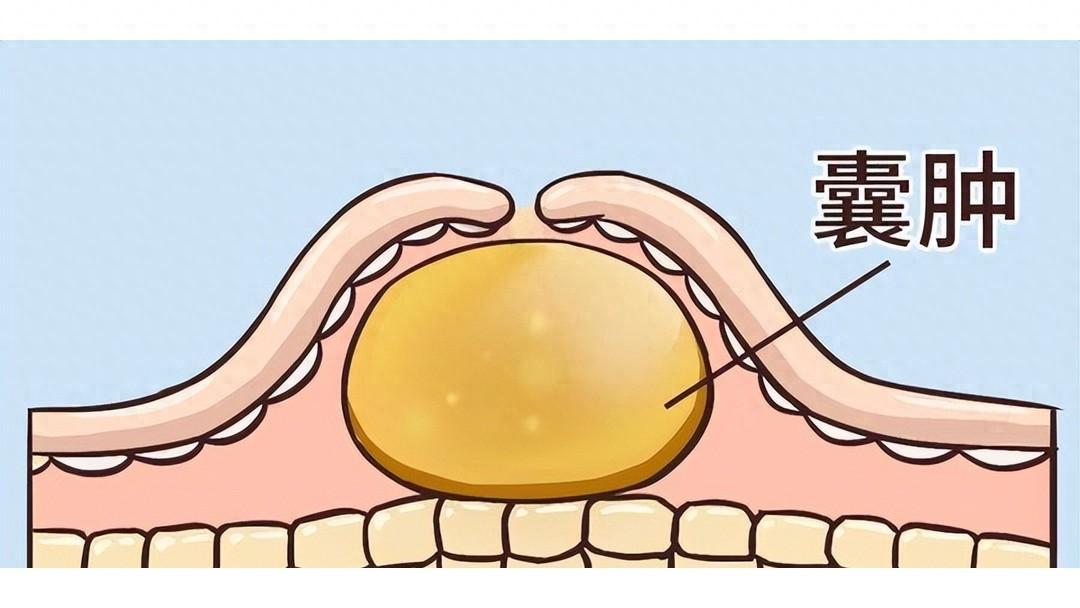 光散结不补阳，结节囊肿必反复！一味中成药连根散结，标本同调内容仅供参考，如有不