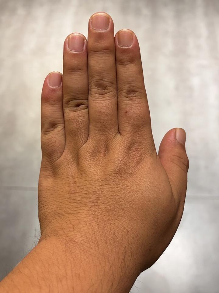 右手麻了快六年，一直当成颈椎病，医生一句话点醒我我的右手麻木，整整纠缠了我将