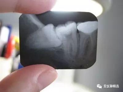 智齿很疼, 哪种情况下的智齿需要拔?