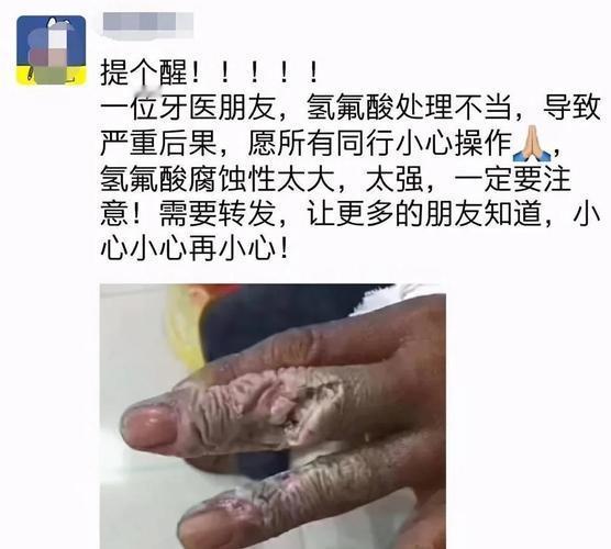 不慎碰到氢氟酸别慌！第一时间用大量清水冲洗至少15分钟，若皮肤有破损或出现疼痛加