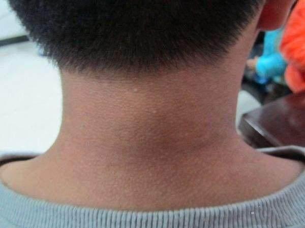 脖子上总是黑黑的洗不掉? 别不当回事, 很多人最后患上了这个病