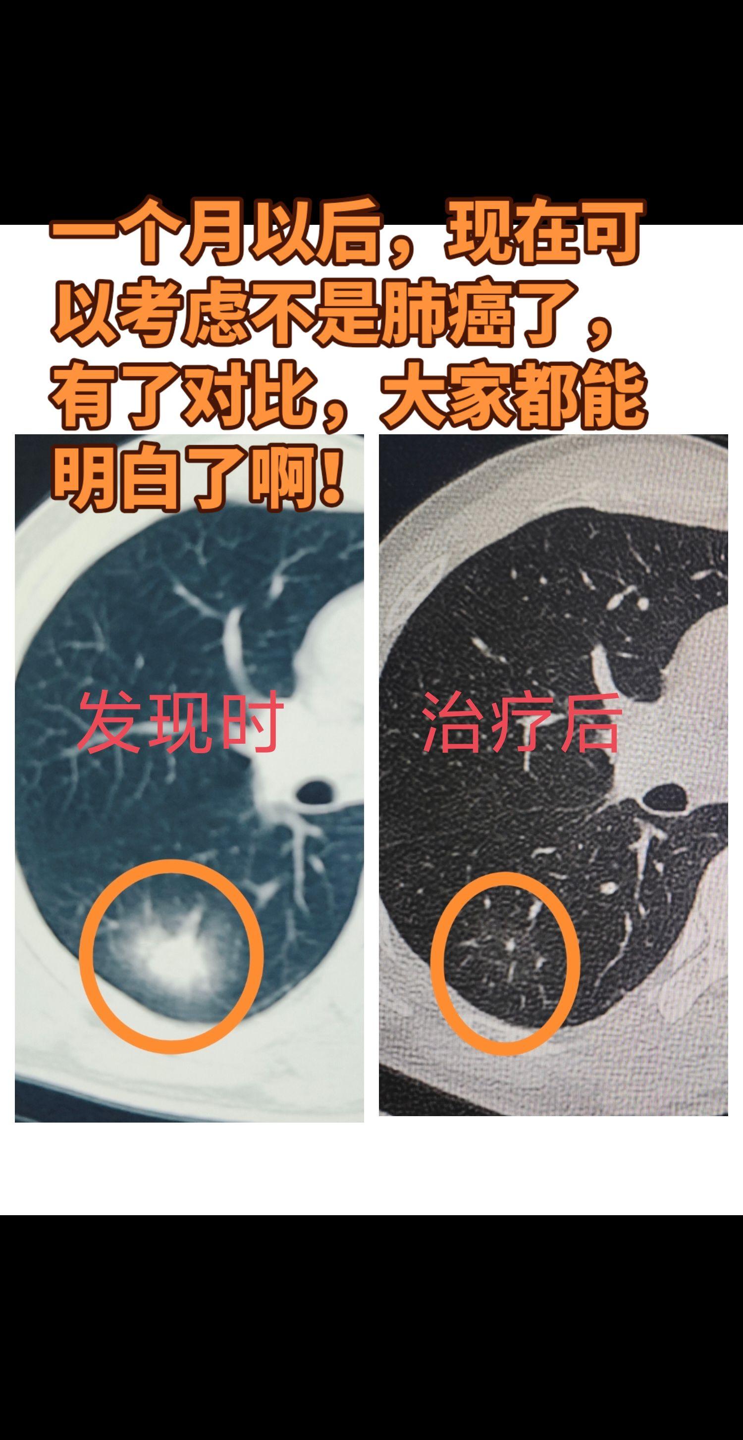 有些肺结节，只不过虚惊一场罢了。一个月以后，现在相信不是肺癌了啊，有了...