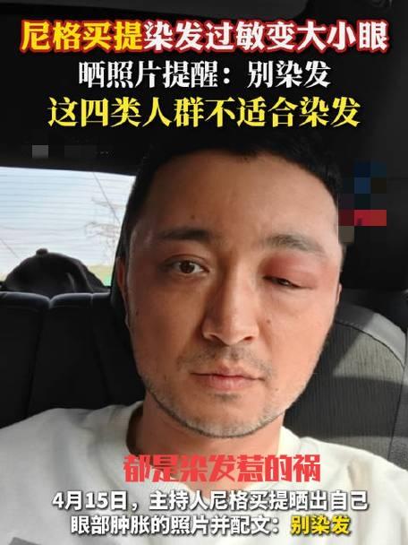 尼格买提不再隐瞒，自曝病情若人揪心，给所有爱❤美发的人“保命指南”给你提个醒