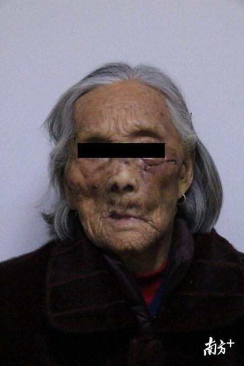 93 岁阿婆脸上长鸡蛋大肿瘤, 医生勇闯“禁区”为她恢复容颜