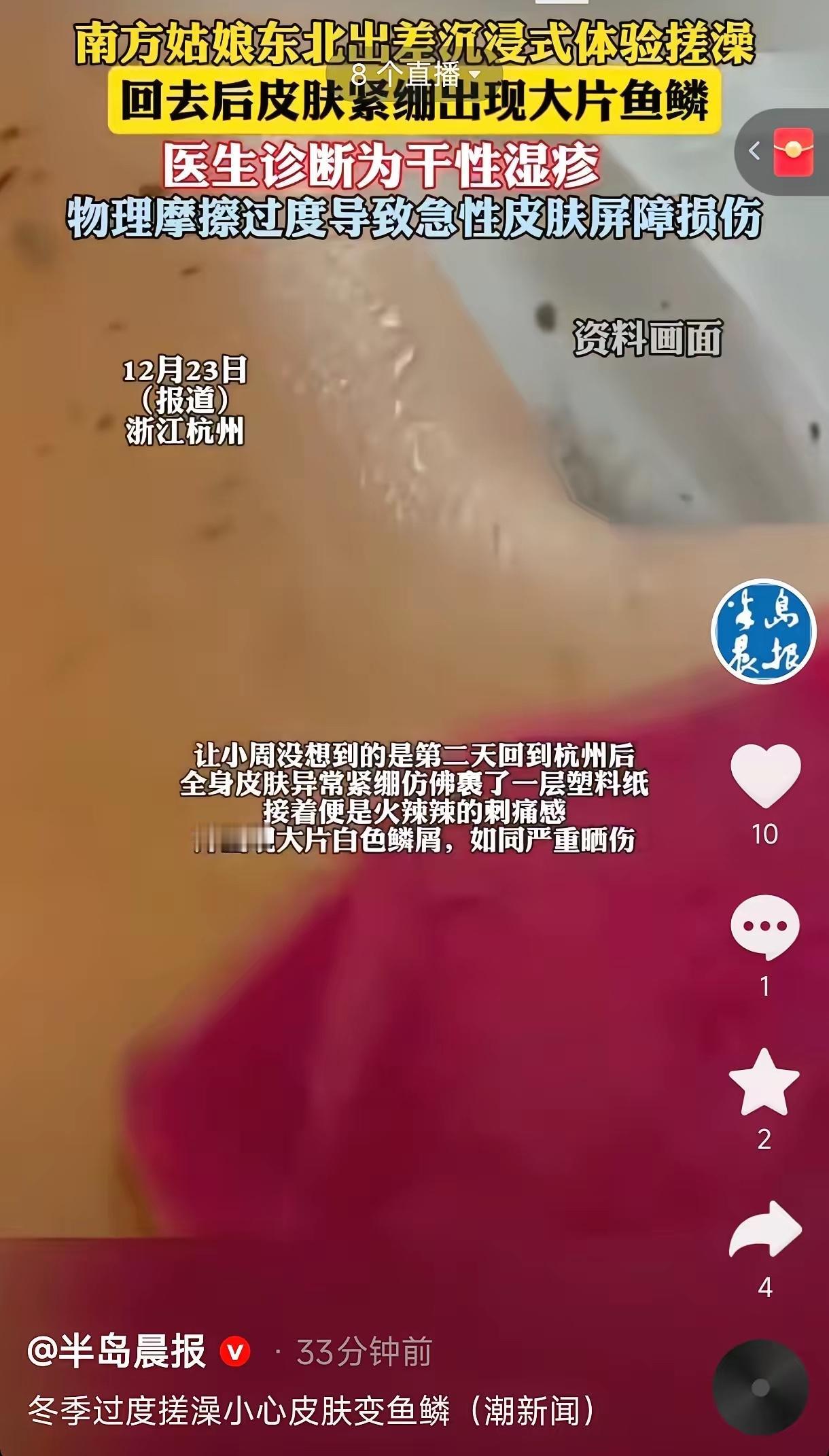 浙江杭州，一女子去东北出差，到澡堂体验了一次搓澡，结果次日全身皮肤紧绷瘙痒，皮肤