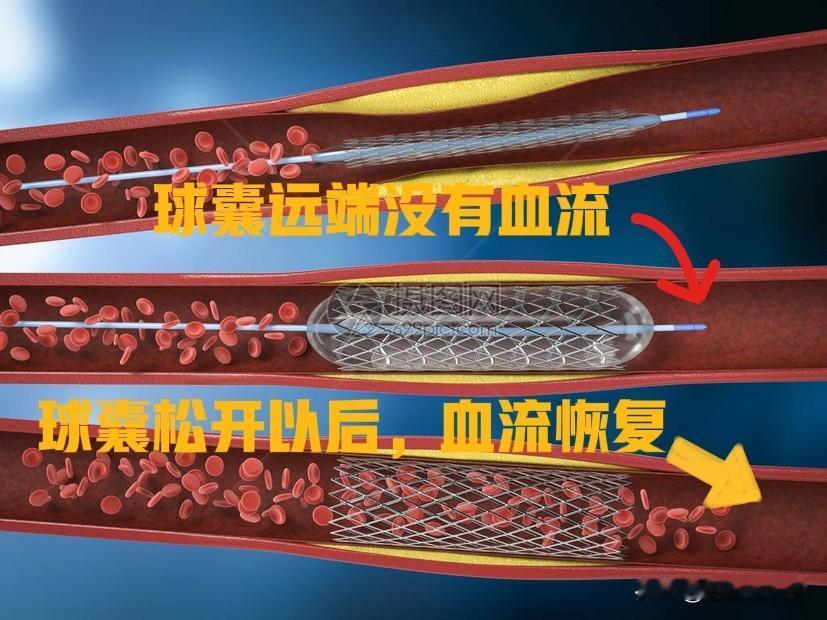 心脏支架手术当中为什么会感觉胸痛？很多做心脏支架的朋友都反应在手术过程中有明显胸
