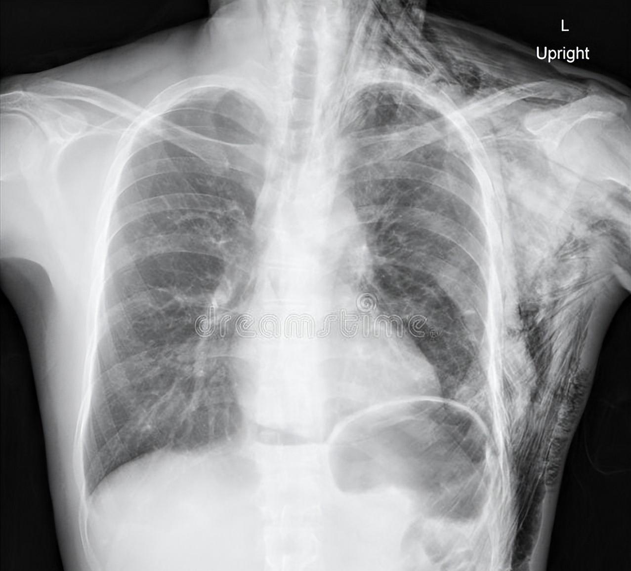 肺结节术后反复咳嗽？这些原因要分清肺结节术后咳嗽是临床常见现象，多数患者会在术