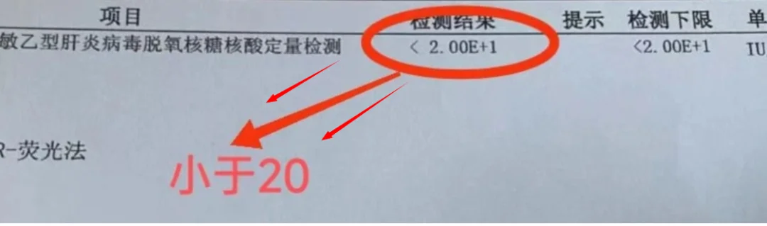 乙肝不吃药没事 吃上反而肝硬化了？ 这是上午接诊的一位肝硬化患者，吃恩...