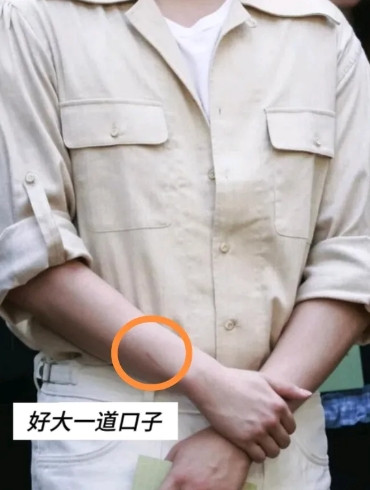 好长一道口子！头哥的胳膊怎么了？头哥在参加奈斯派克咖啡线下活动的时候，眼尖的网友