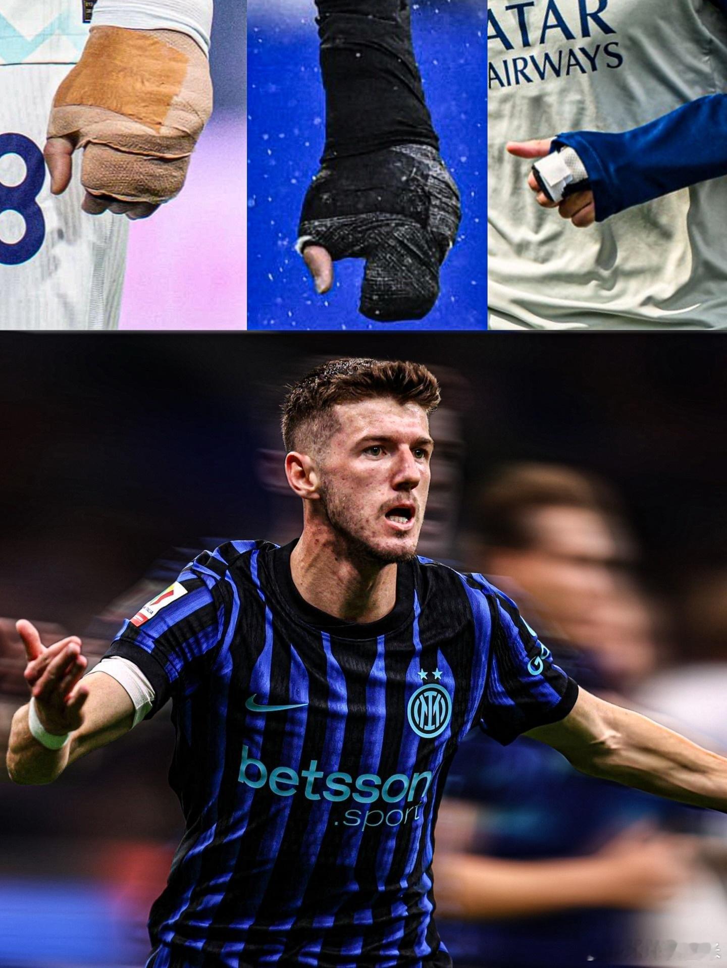 【铁血硬汉】齐沃：苏西奇手部三处骨折，打着石膏为国际米兰出战，我必须向这个孩子脱