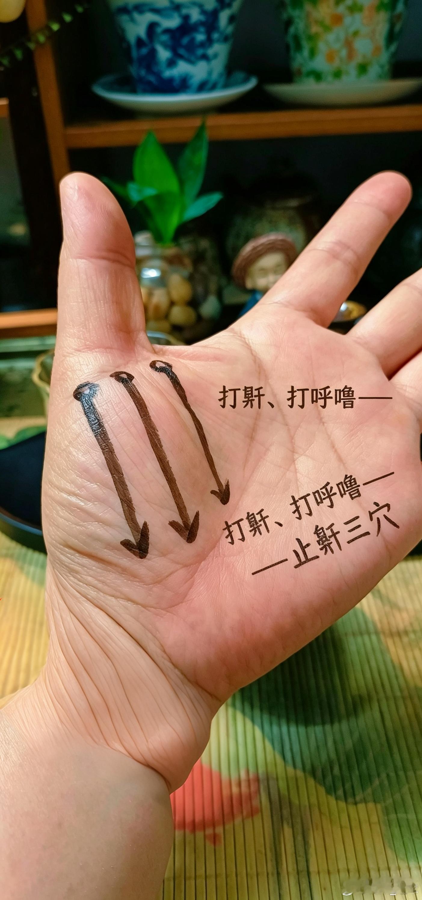 止鼾三针（指代针版）+小儿腺样体肥大专项方案结合原针法，适配小儿群体，全程改为以