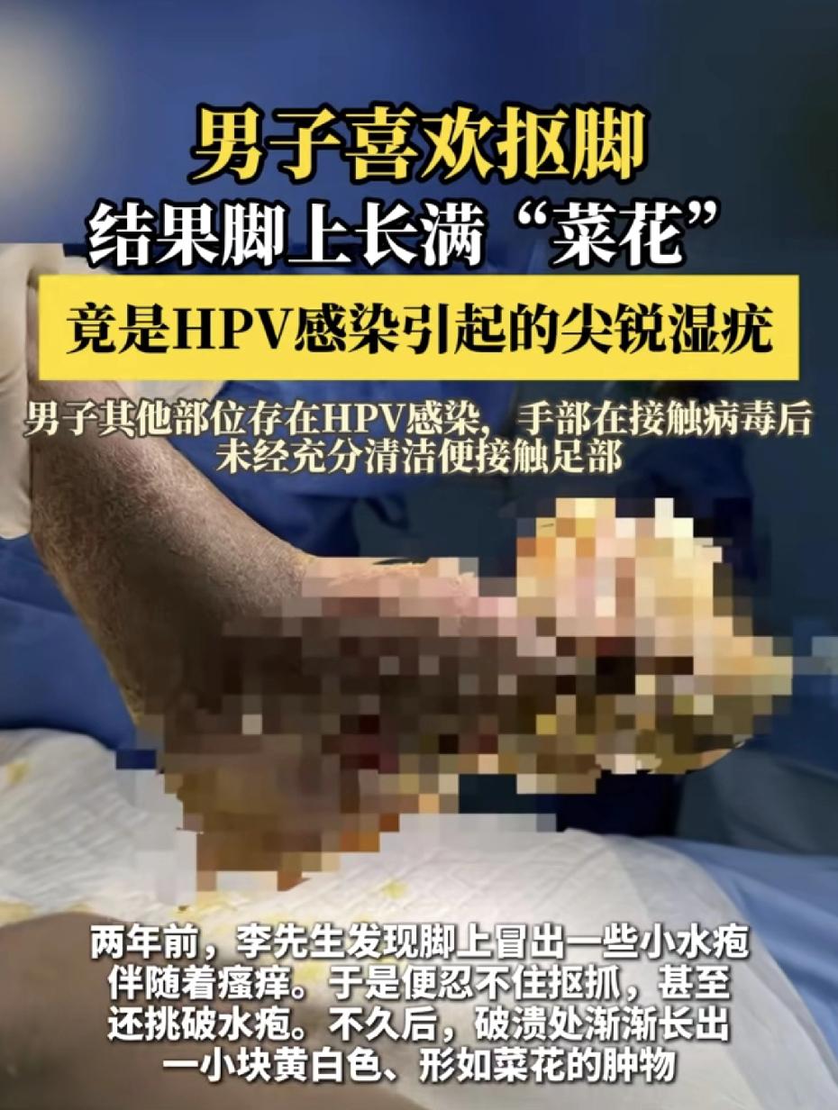 恶心到惊呆我了！抠脚抠出一脚“菜花”，你听过这种事吗？有个大哥，平时就爱抠脚，