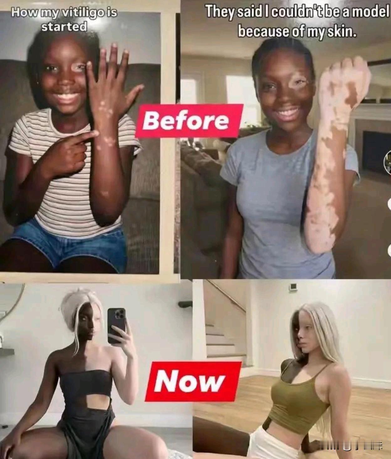 黑人得了这个病，直接换了个人种