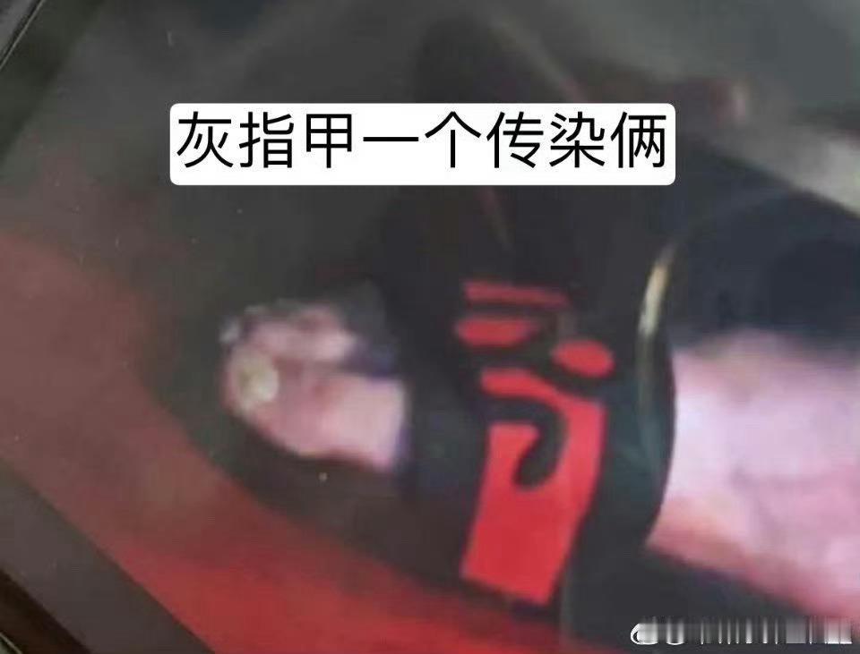 田栩宁灰指甲柠檬水真的可以治灰指甲嘛不行的话试试哥哥洗澡水​