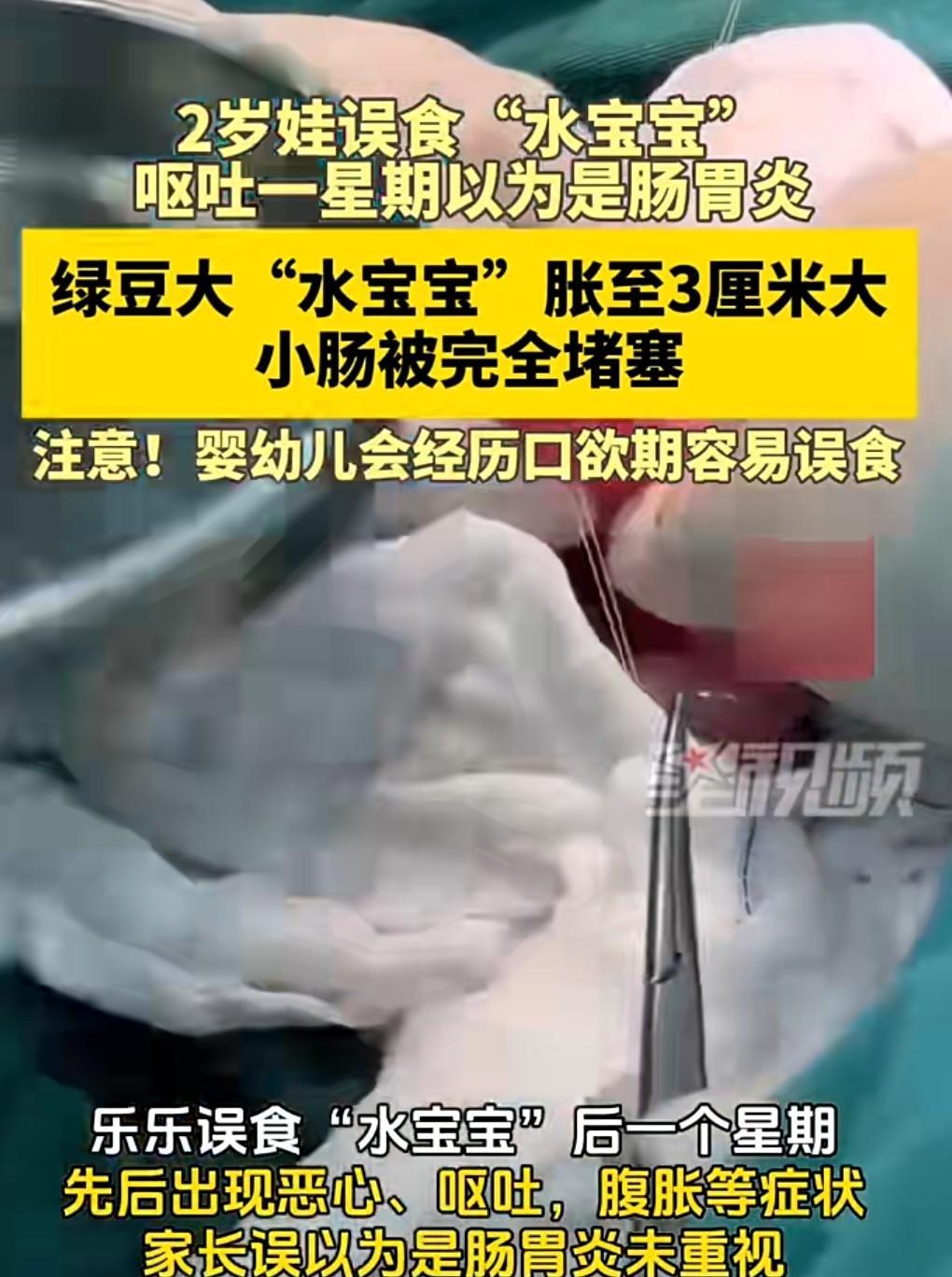 这真是敲响警钟啊。千万不要给幼小的儿童买水宝宝、磁力珠这样的玩具。近日，一名