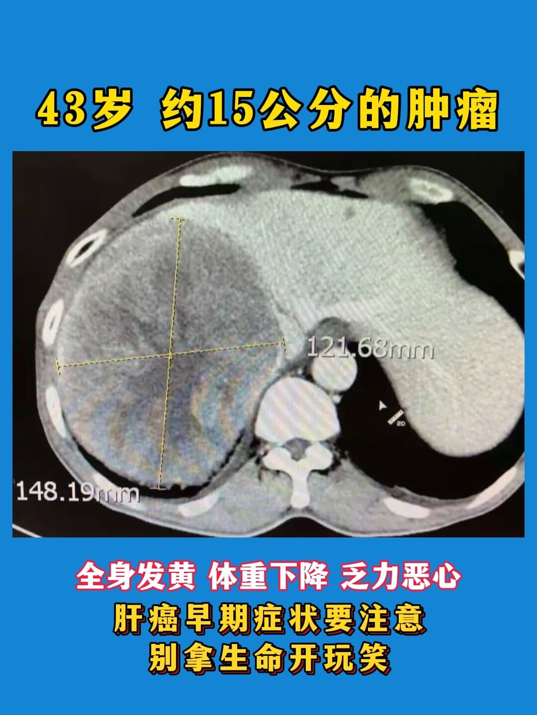 15公分大的肿瘤在肚子，怎么会不难受？。这是今天接诊的一位肝癌患者，年...