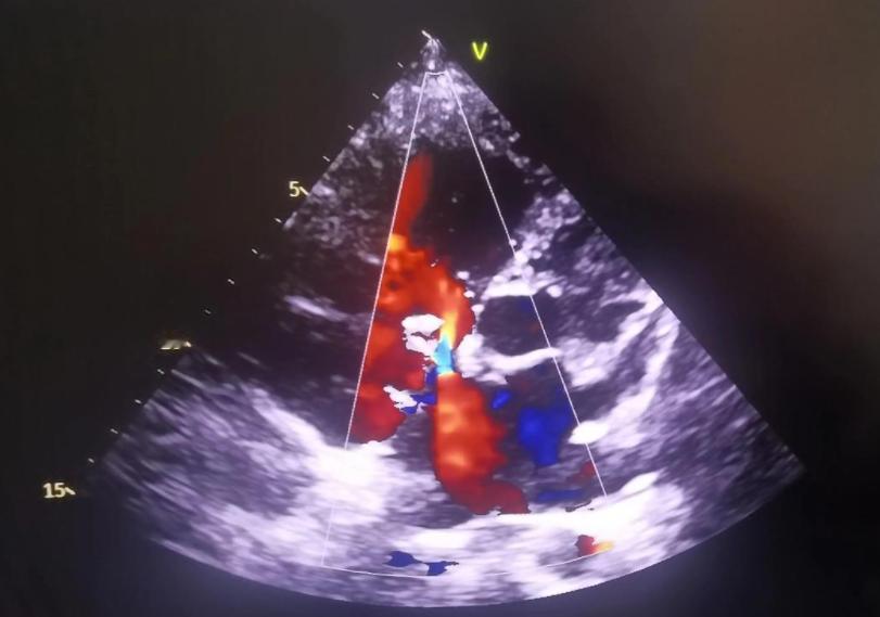 为啥很多人不愿做心脏彩超？医生：做一次筛查，或能5年远离心衰： 你有没有见过