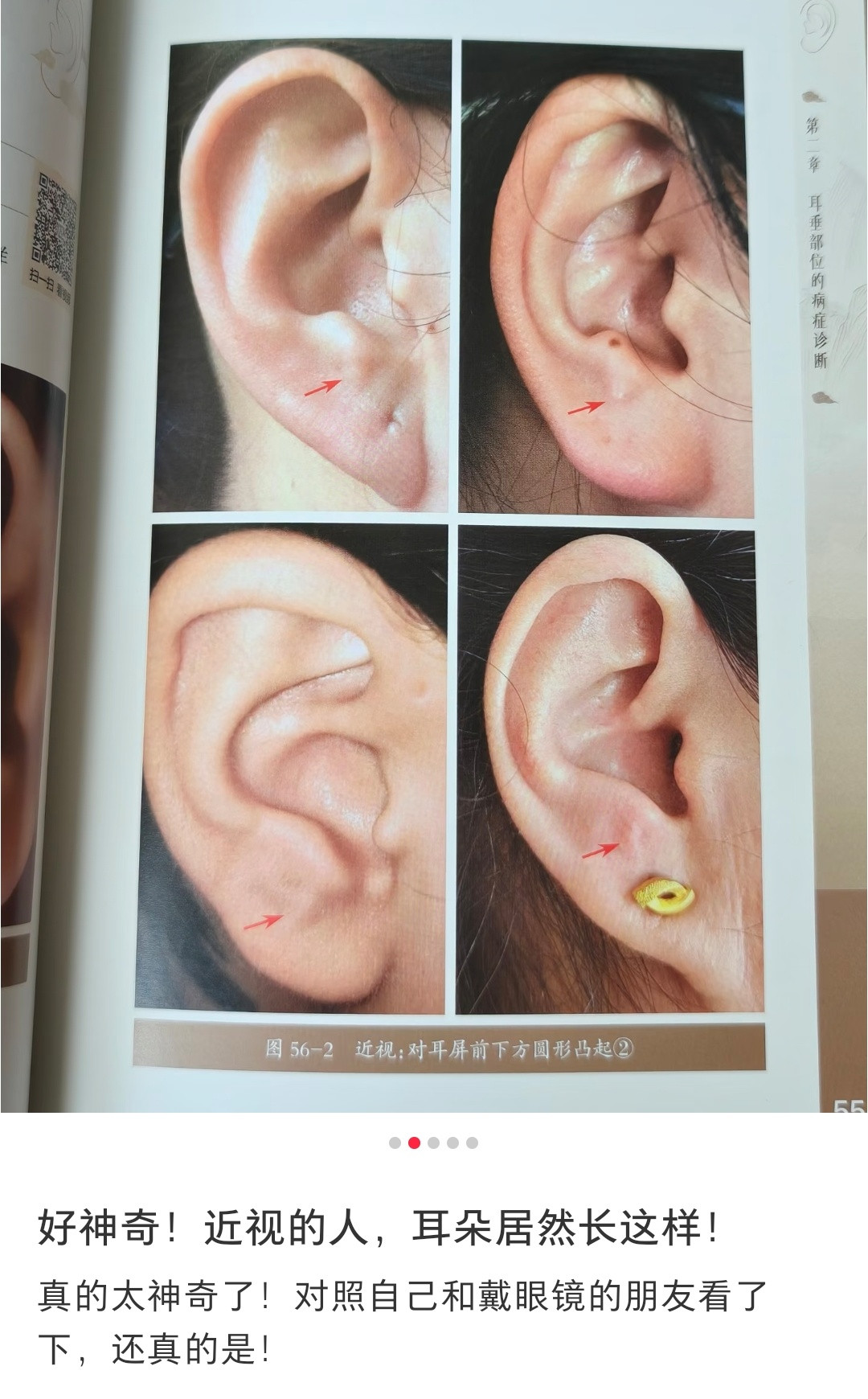 近视的人耳朵对耳屏下方会有圆形凸起？但是这个也不需要看耳朵吧，近视不近视这个多明