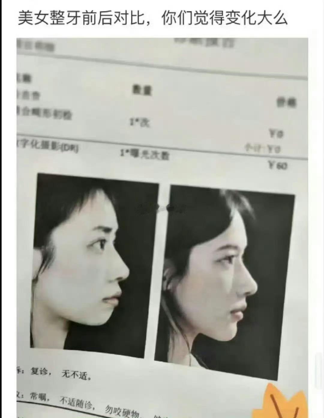 这哪是整牙的变化啊，这简直是进化了。​​​