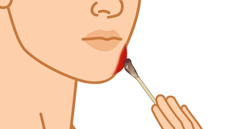 碘伏再次成为关注对象！医生发现：使用碘伏，千万多留意这几点碘伏作为一种常见的