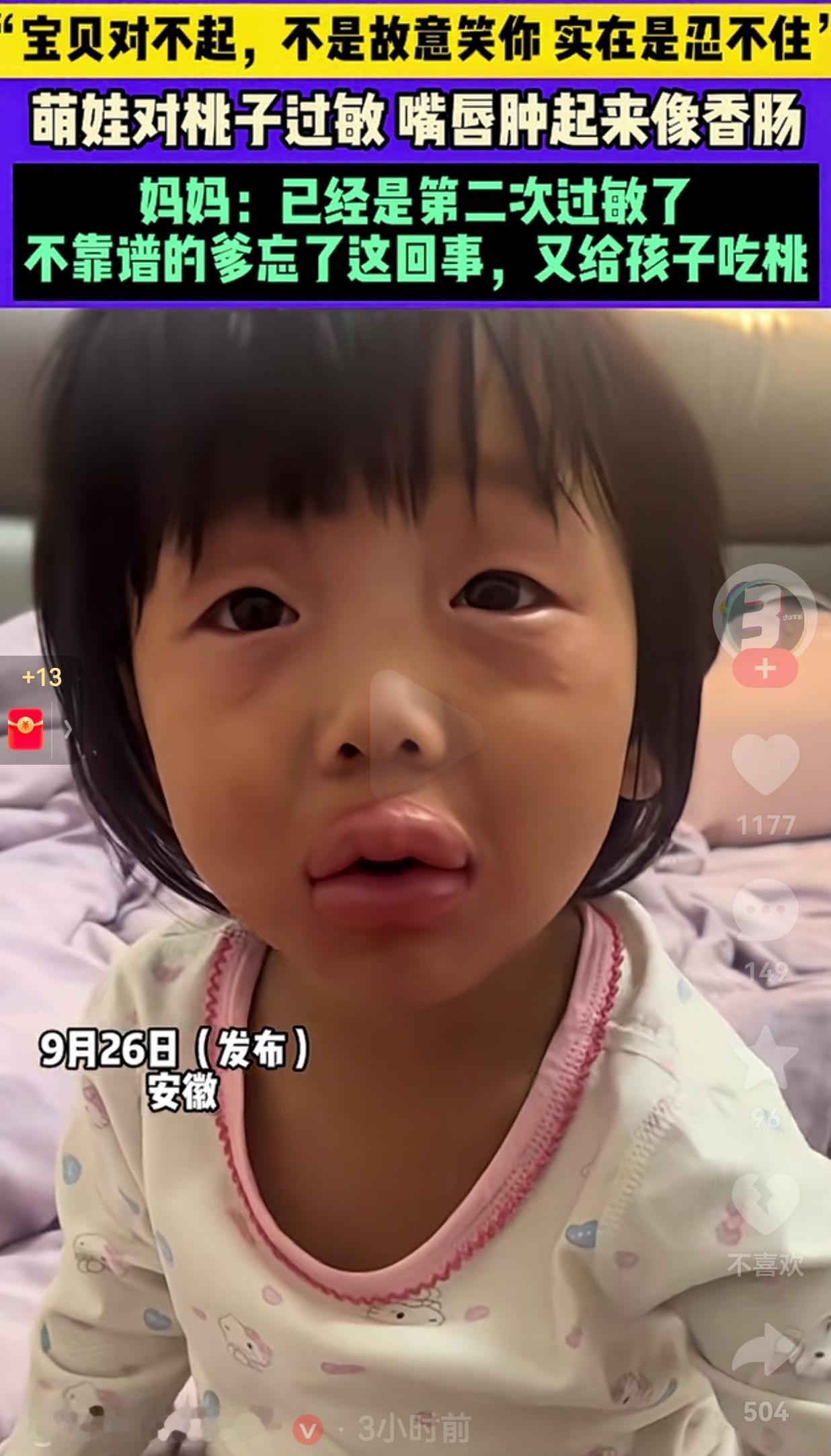 不靠谱的爹，憋不住的妈！近日安徽一萌娃吃了爸爸喂的桃子，嘴唇肿了起来，看起来就像
