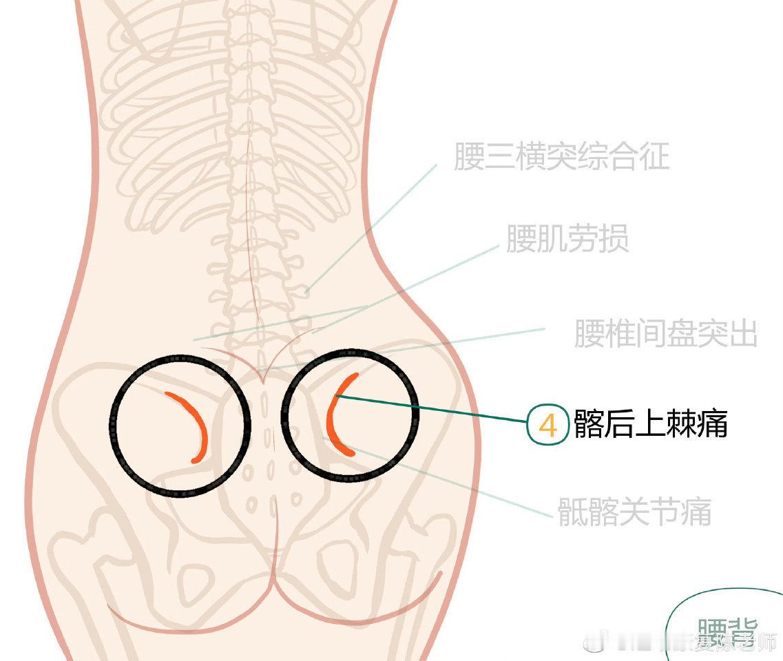 腰痛康复趁着假期，巩固复习一下腰背知识——腰肌劳损、腰椎间盘突出、骶髂关节、筋