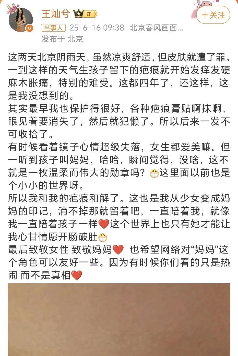 王灿和疤痕和解了！6月16日，王灿分享了生孩子留下的疤痕在这样的天气开始发痒发