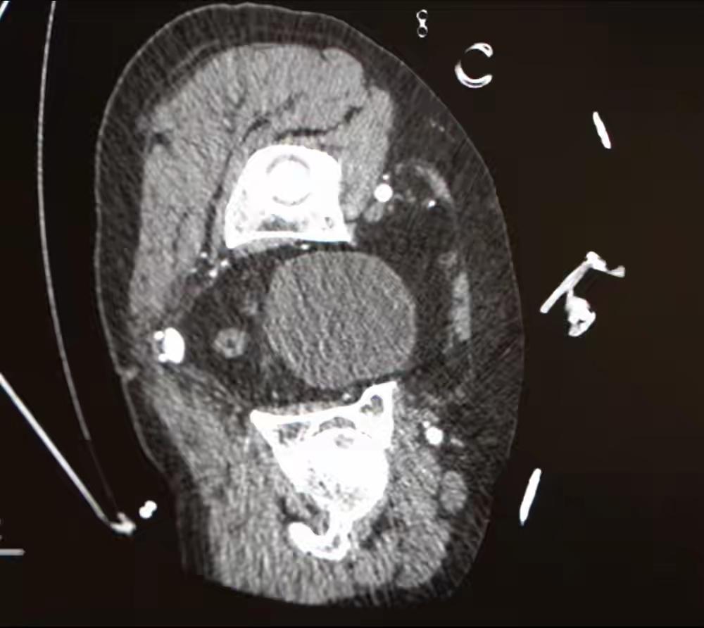 修理师傅弯腰修水管，身体的“主水管”却突然喷血，心脏几乎“空转”!医生提醒：如出