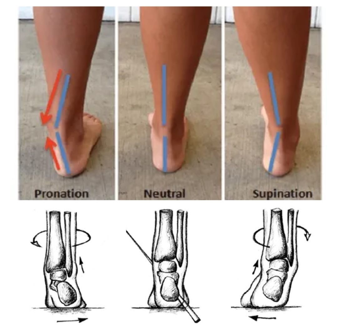 运动康复你的下肢疼痛根源，可能就隐藏在你的脚里。来观察下自己的脚踝力线，你是1