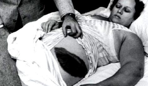 1954年，一位异国女子在睡梦中突然感到腹部与大腿传来钻心刺痛，仿佛被烈火灼烧。