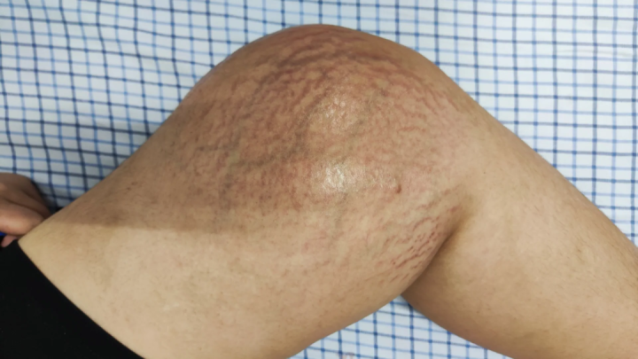 我要怎么告诉孩子, 她可能要失去一条腿……她才9岁啊!