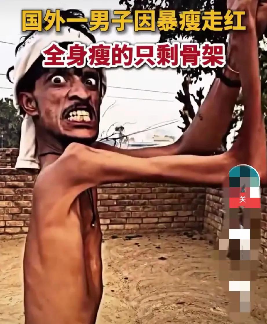 国外一名男子因暴瘦引起广泛关注。从画面中能看到，他身形极度消瘦，骨骼轮廓清晰可见