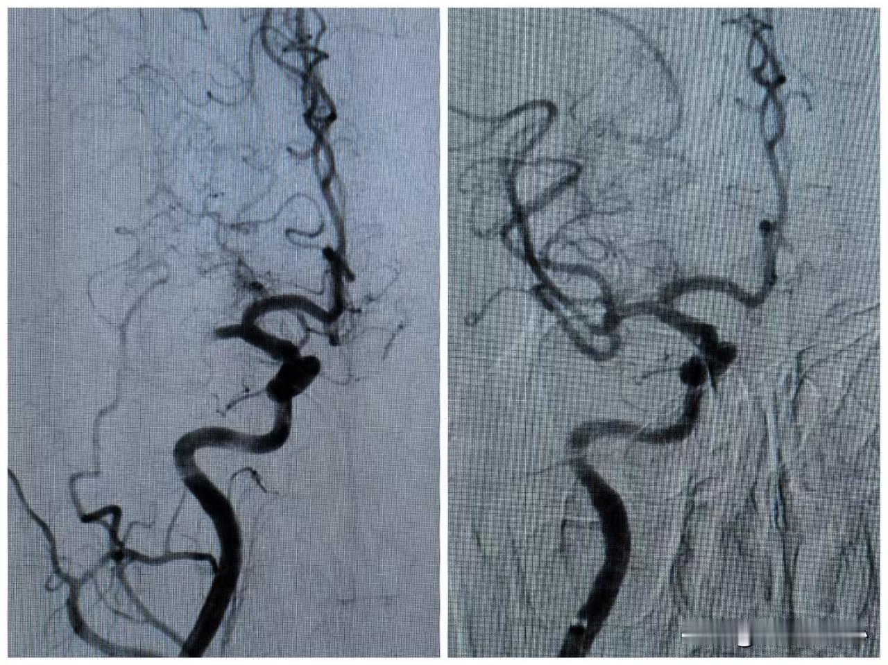 房颤患者突发肢体乏力要警惕脑卒中！昨天上夜班就碰到这样一例患者。这是一位49岁女