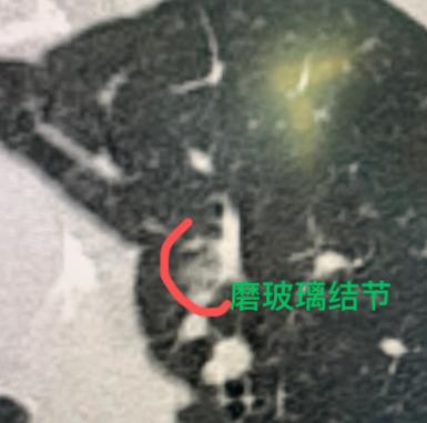 65岁的患者体检发现双肺都有结节,左肺近1cm的磨玻璃结节,当地医生说考虑是早期