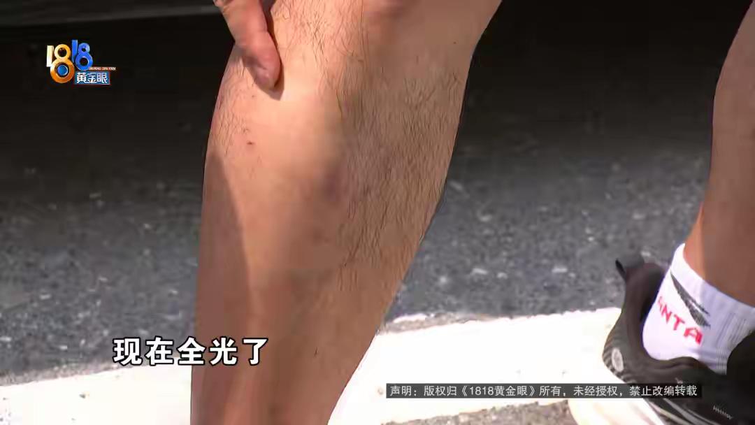浙江诸暨，男子开新能源车1年，突然发现自己两条腿上原本茂密的毛发，竟然都掉秃了，