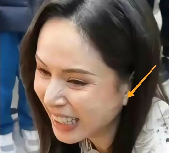 搞不懂了，李若彤不是没有医美过吗？这耳前凸起的一条线是啥​​​