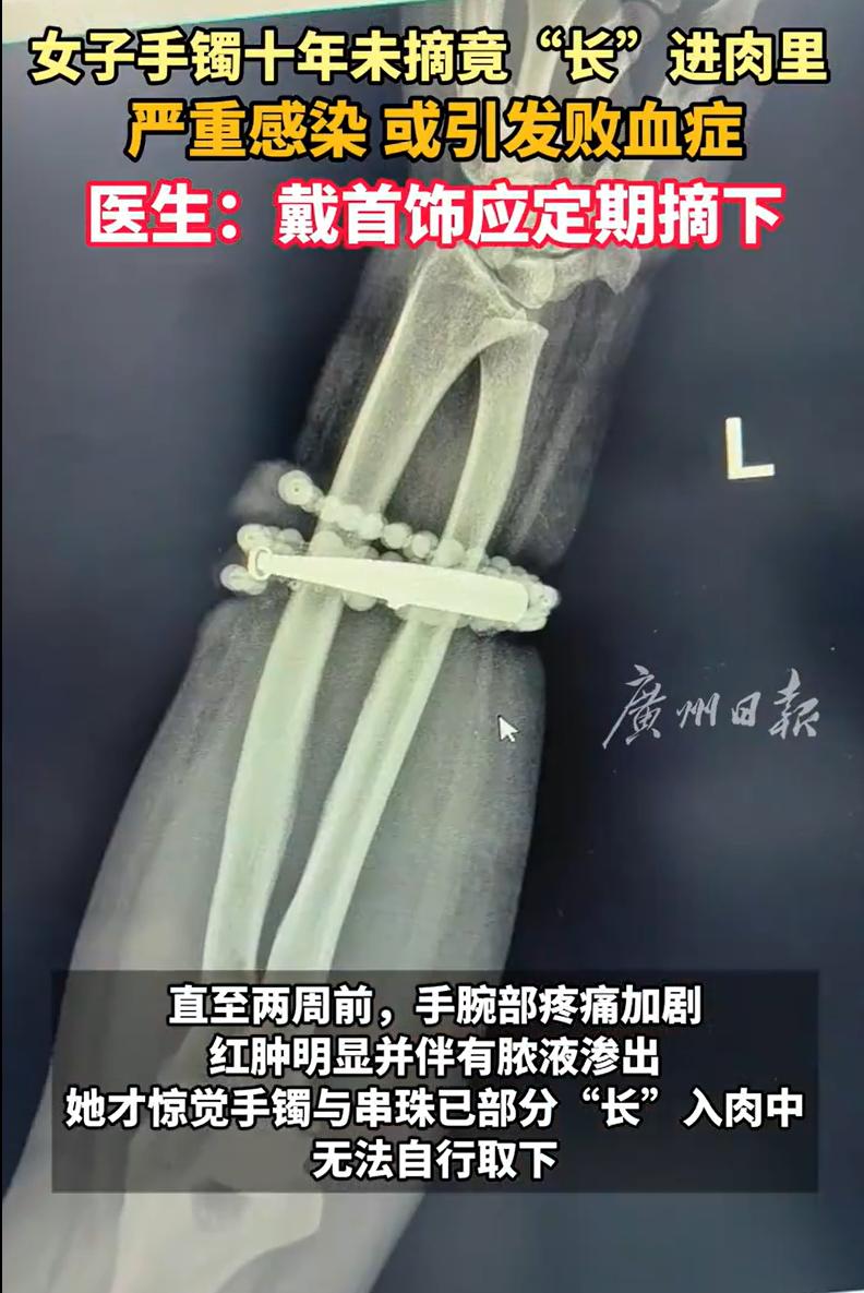福建宁德，女子发现手腕的位置反复疼痛发痒，开始还以为是皮肤发炎，可随着疼痛加剧，