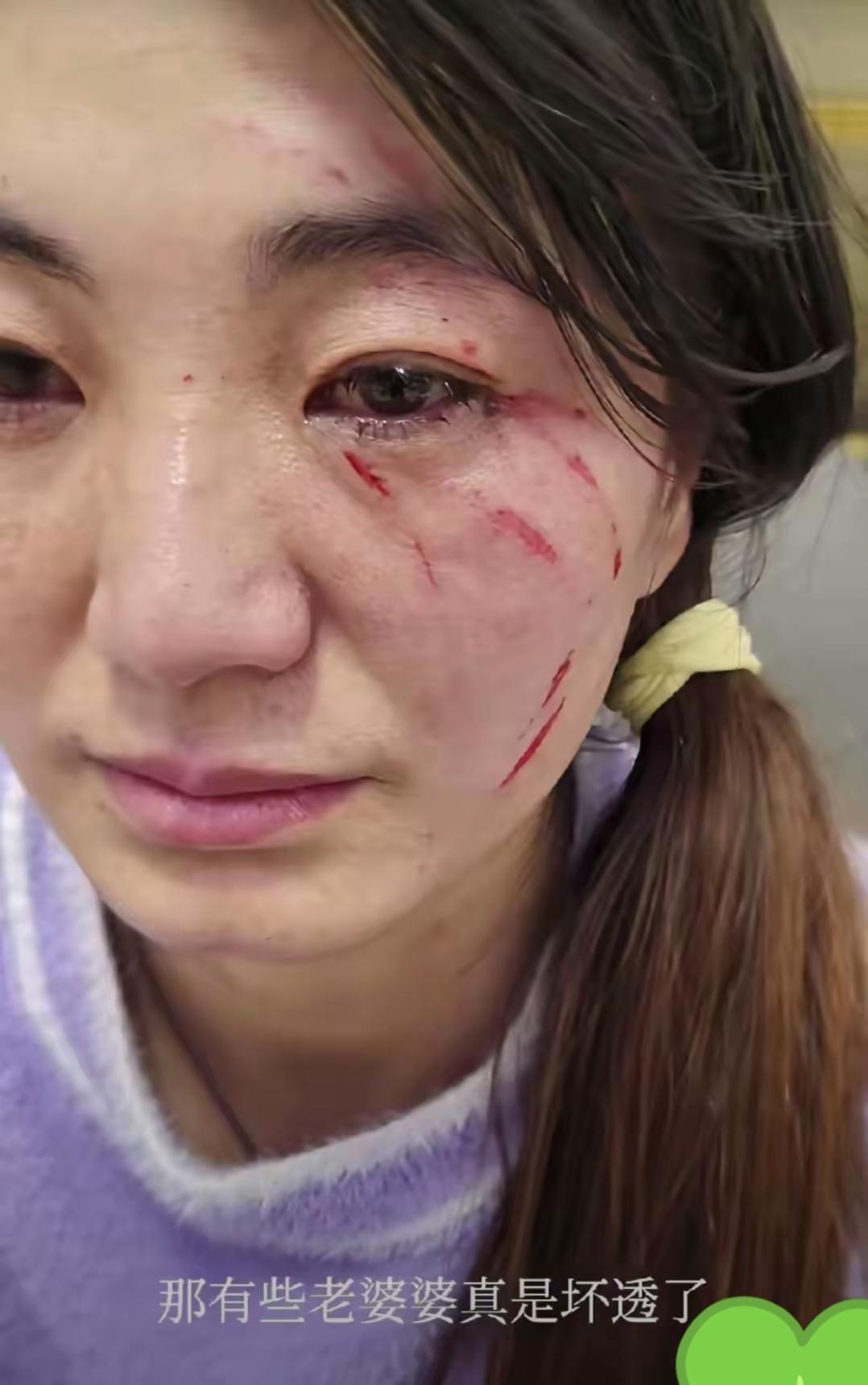 刚刚刷到一个网友，居然被婆婆打成这样，这么强势的婆婆，很少见吧，我是没见过，就是