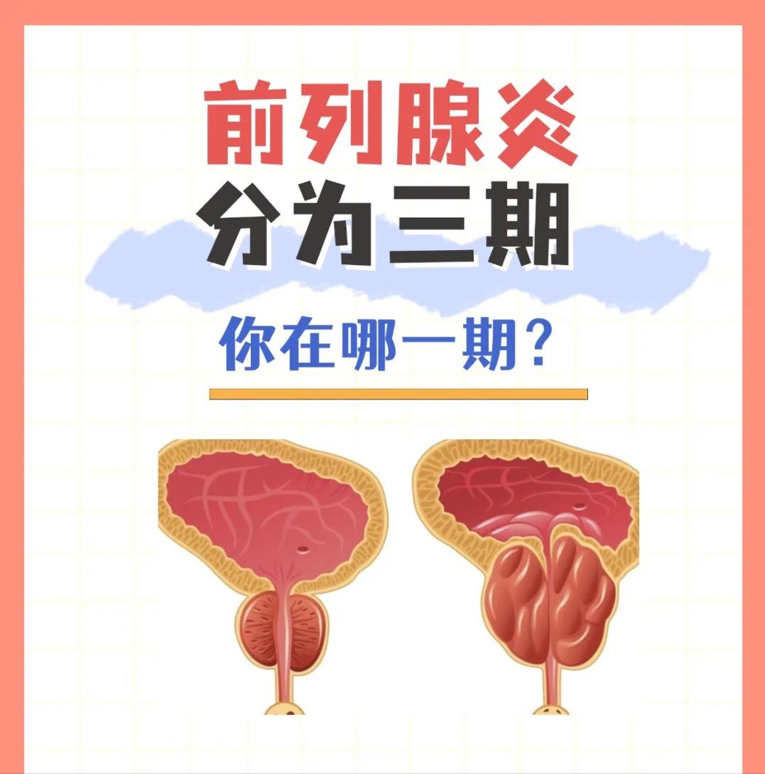 前列腺炎分为三期，看看你属于哪一期？